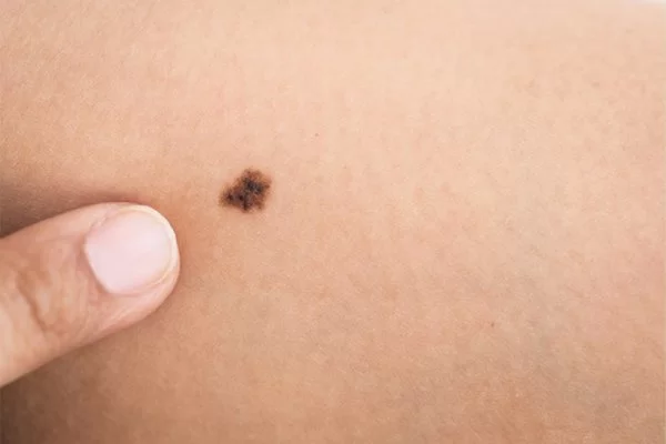Ý nghĩa nốt ruồi ở nhũ hoa bên trái